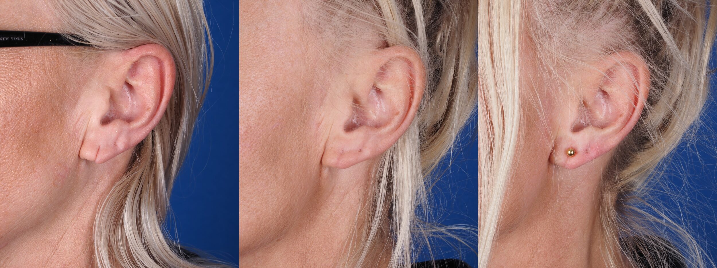 Before and After Image: Earlobe Reconstruction