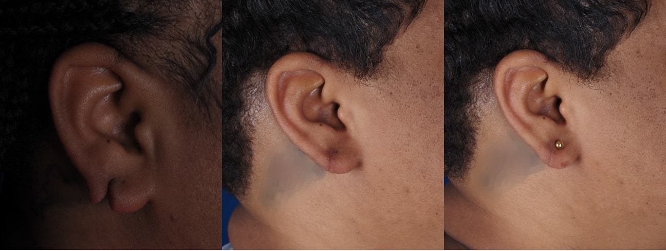 Before and After Image: Earlobe Reconstruction