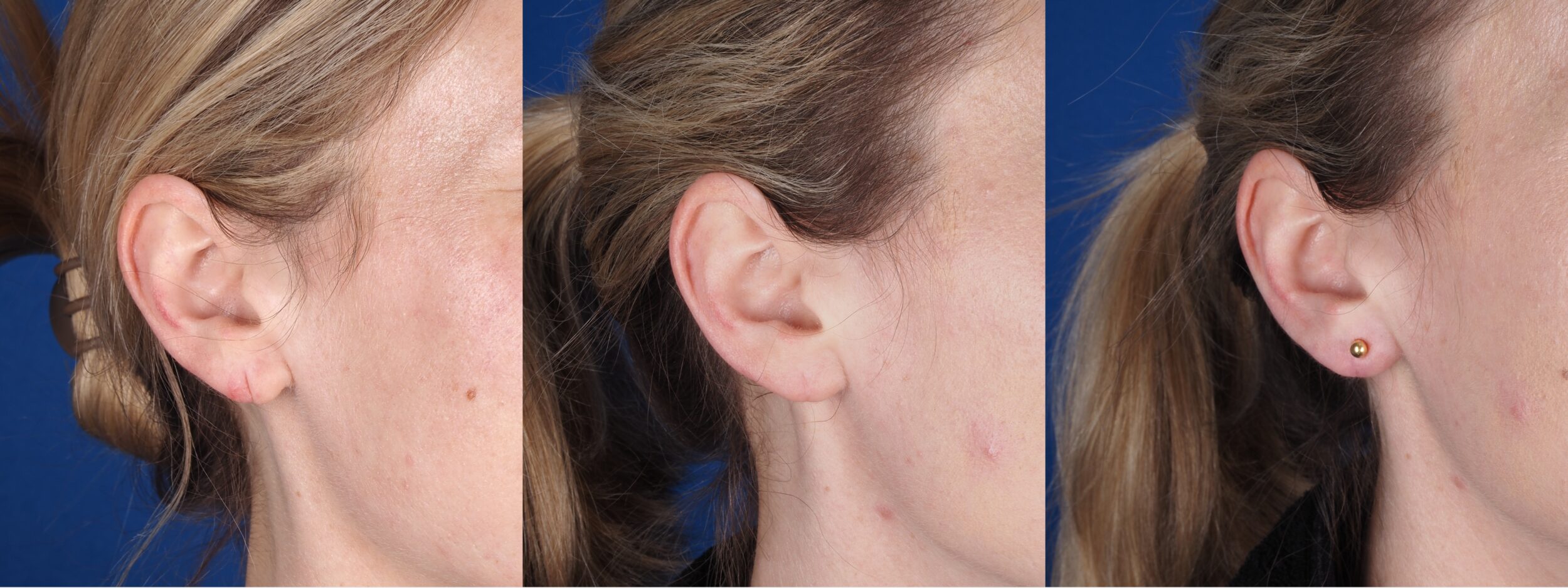 Before and After Image: Earlobe Reconstruction - front