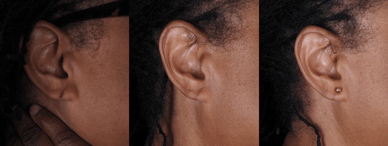 Before and After Image: Earlobe Reconstruction - right-side