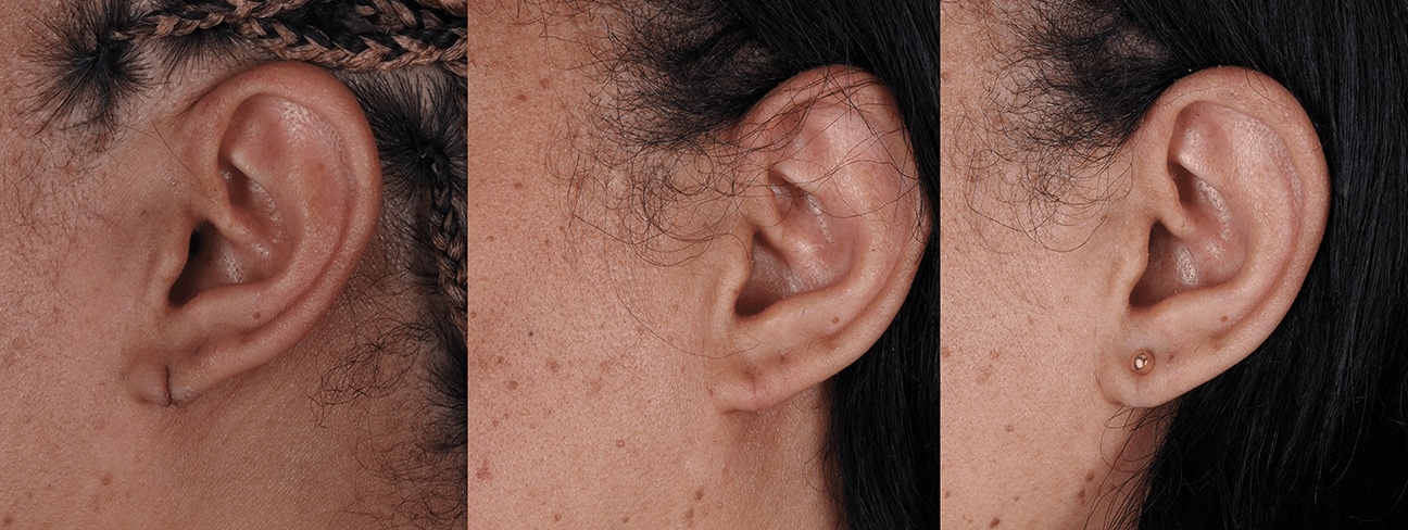Before and After Image: Earlobe Reconstruction - left-side