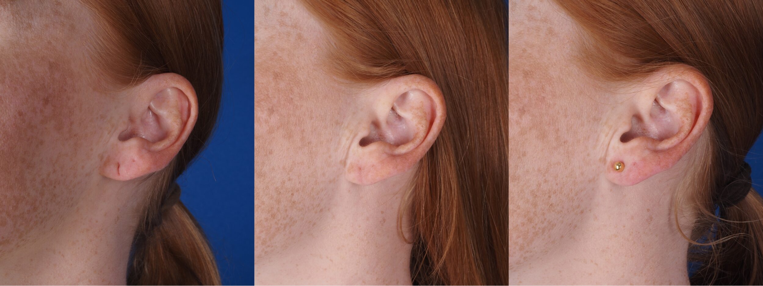 Before and After Image: Earlobe Reconstruction - front