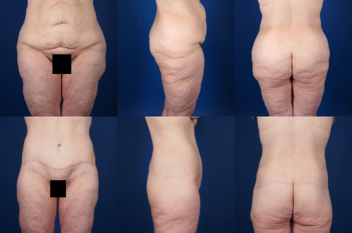 Before and After Image: Body Lift (Circumferential)