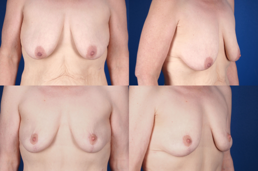 Before and After Image: Breast Lift (Mastopexy) - front